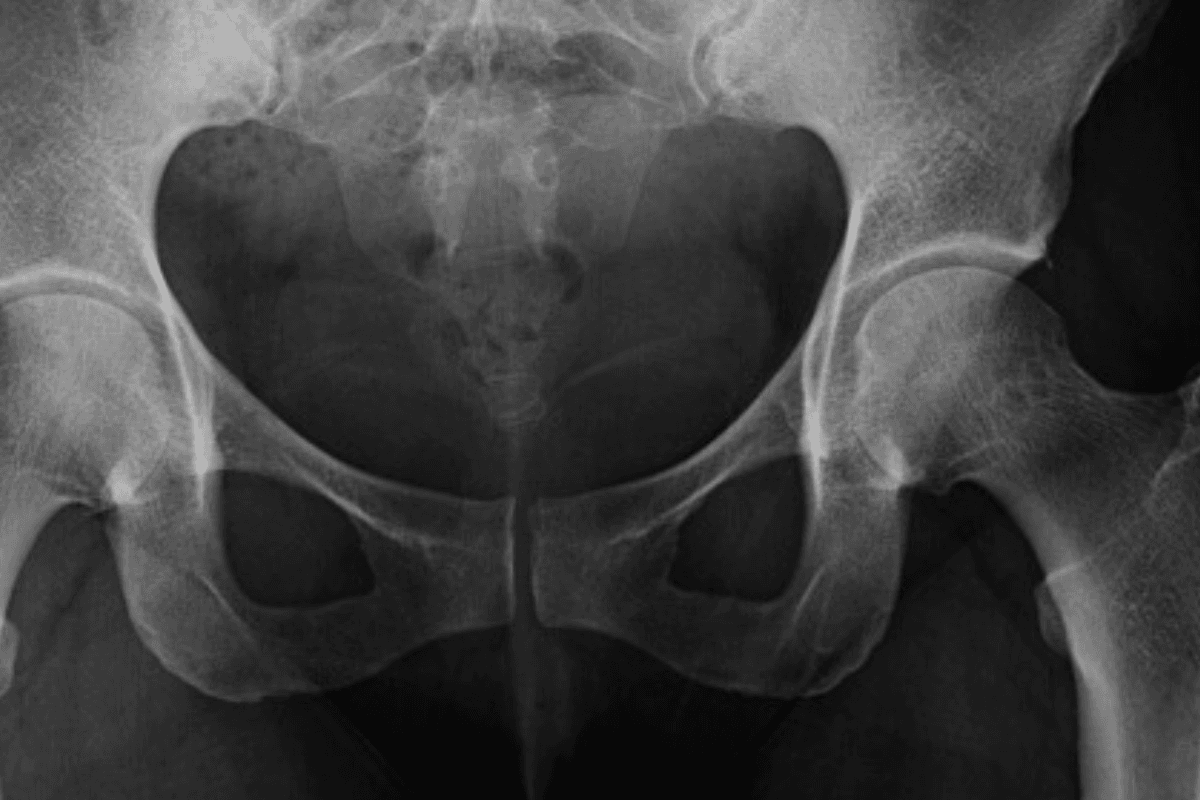 Coccyx X-Ray: When, Why, and How It’s Done