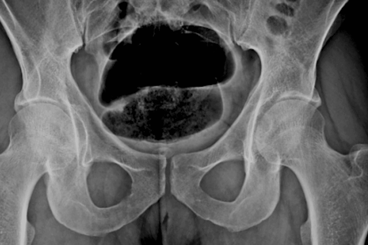 Fistulogram X-Ray: A Critical Test for Fistula Diagnosis