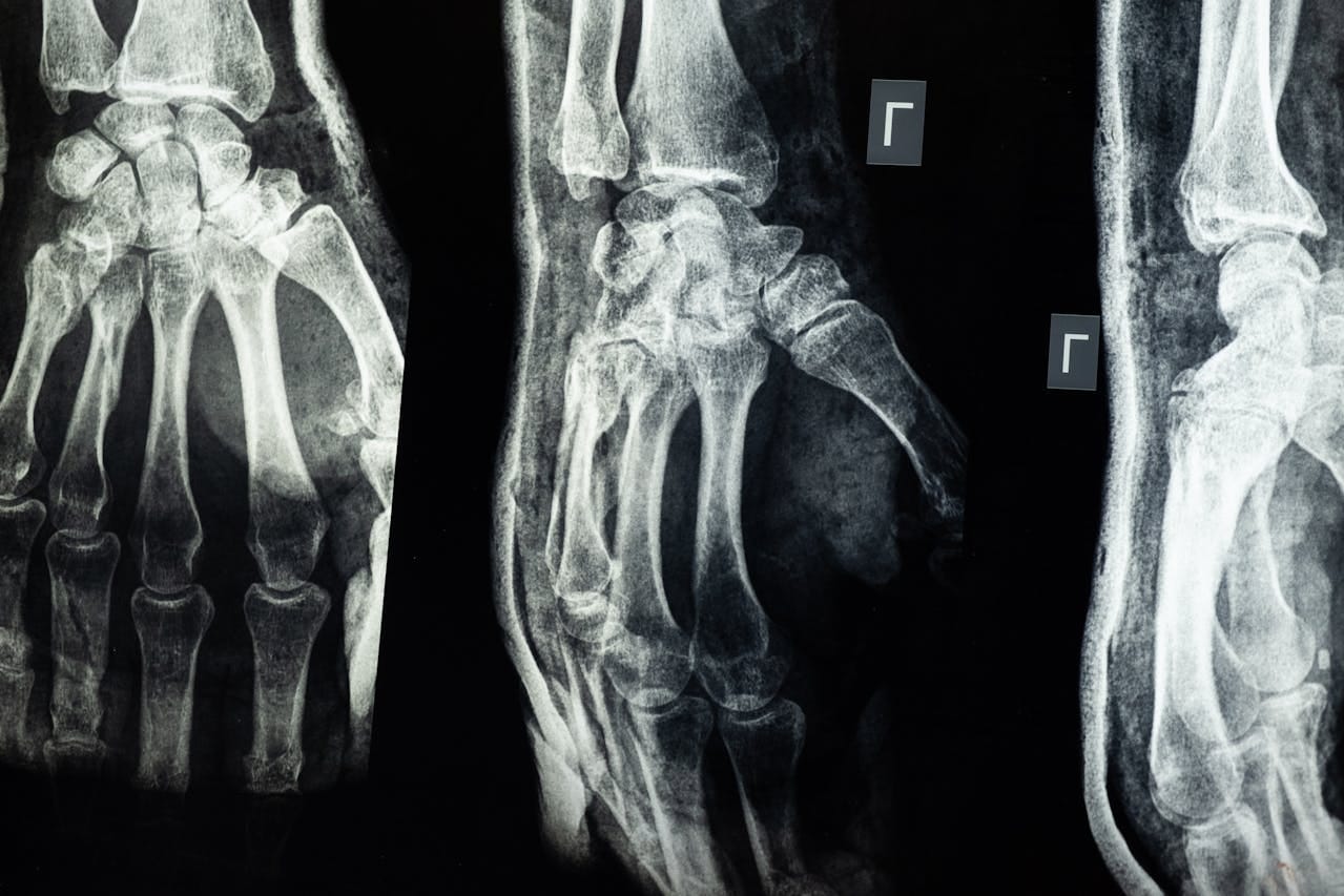 Ossification Test: Understanding Bone Development and Growth