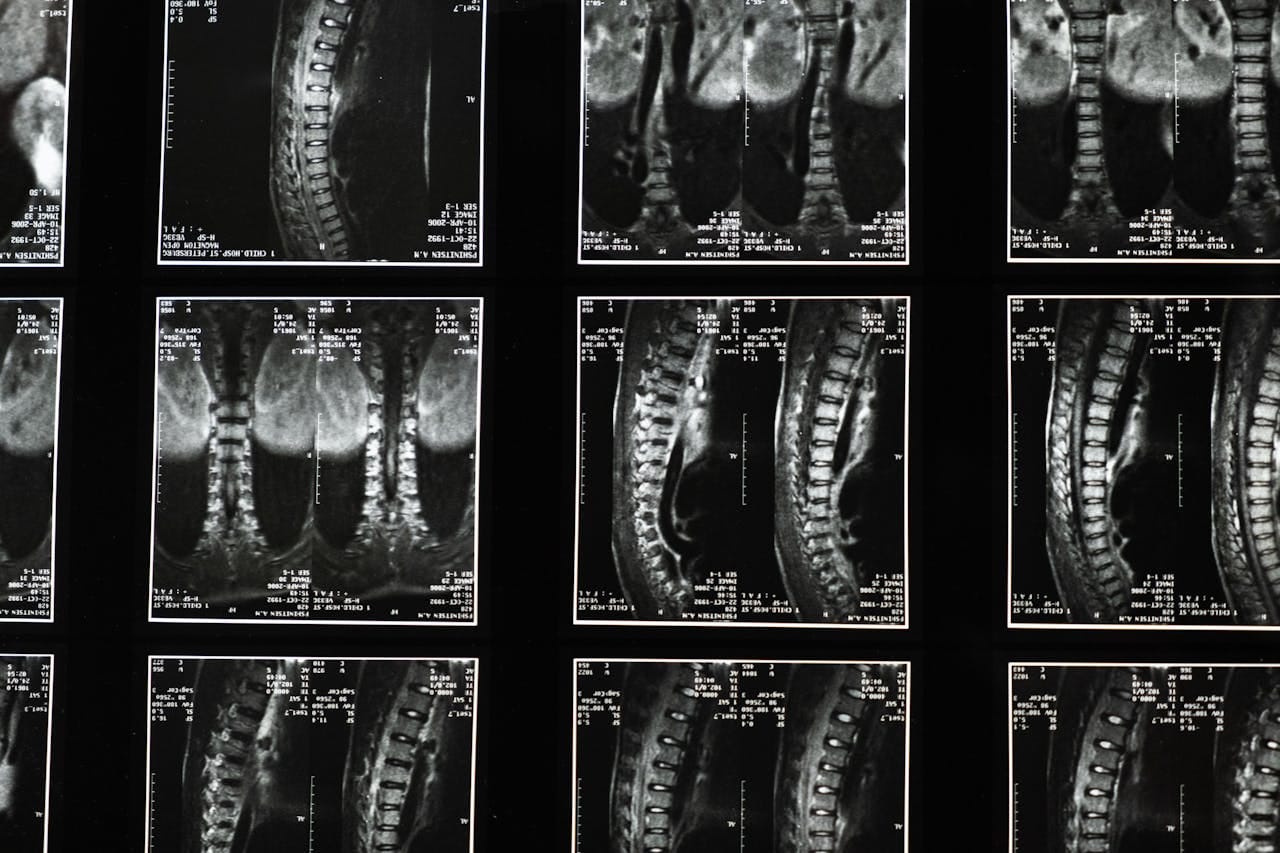 Dorsal Spine X-Ray: A Key Diagnostic Tool for Back Pain