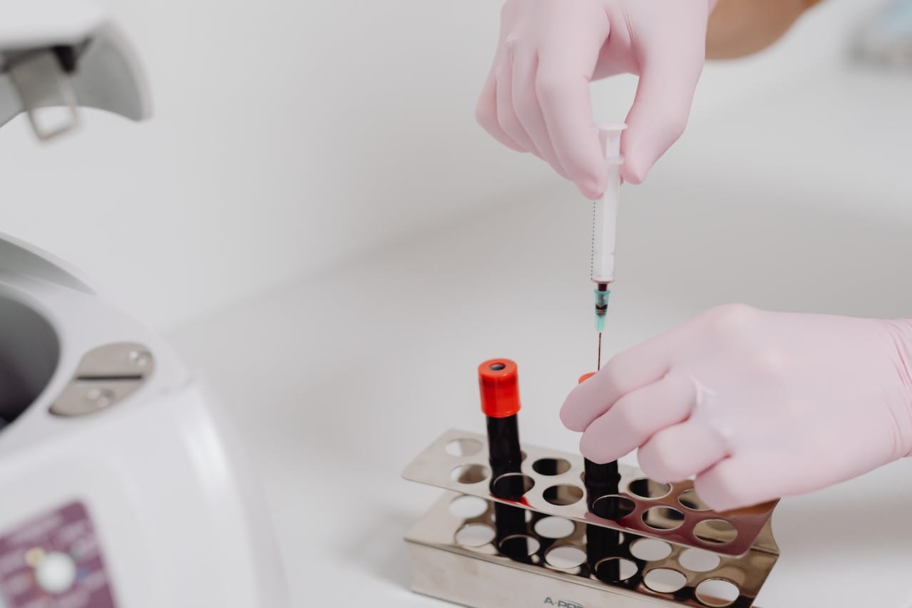 SPEP Blood Test: What It Detects & Why It Matters