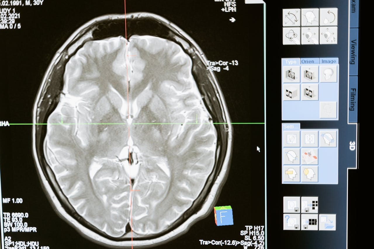 7 Stages of Frontotemporal Dementia: Know Diagnoses and Treatment